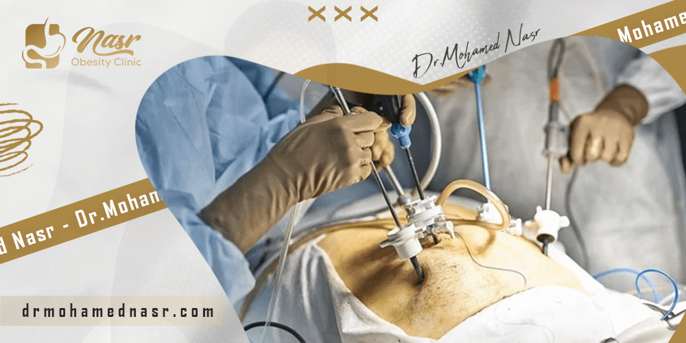 شرح-عملية-تحويل-مسار-المعدة شرح عملية تحويل مسار المعدة