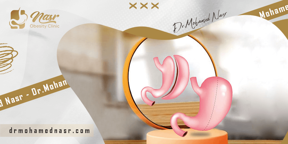 شكل-المعدة-بعد-التكميم شكل-المعدة-بعد-التكميم